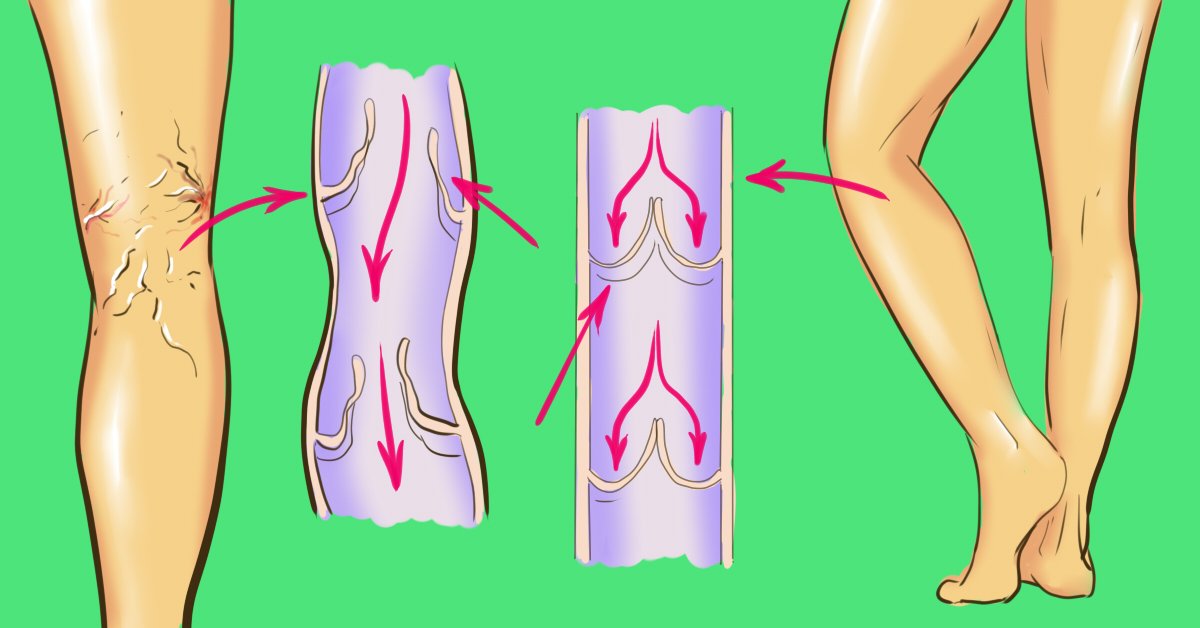 Варикоз Вен Упражнения