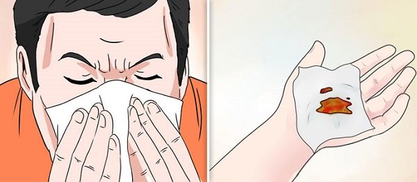 как остановить кровь из носа
