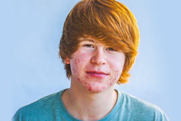 Как лечить акне на лице