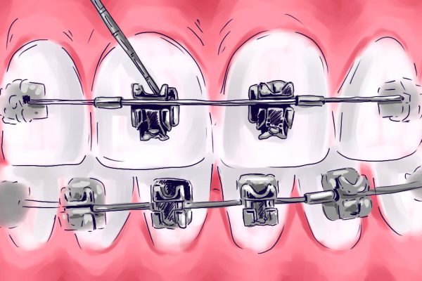Что такое безлигатурные брекеты