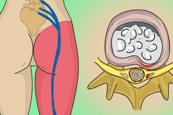 Одно простое упражнение, чтобы избавиться от боли в пояснице и защемления седалищного нерва.