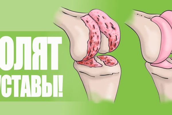 После 40 ржавые суставы дадут о себе знать. Чтобы приготовить натуральную смазку от ноющей и продолжительной боли…