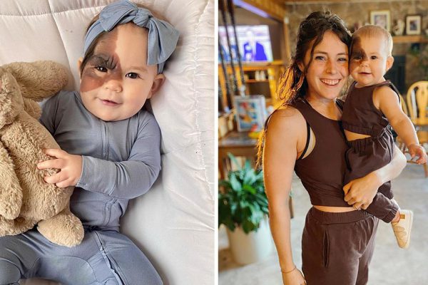 Мама превратила врожденную особенность дочери в еще один повод восхищаться малышкой