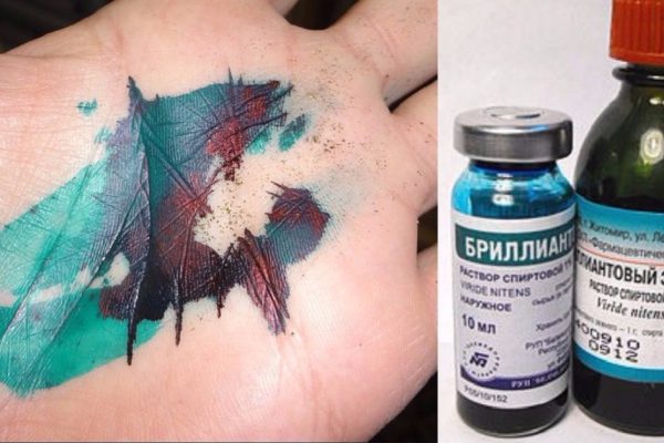 Бриллиантовый зеленый… Вот почему раствор для наружного применения не используют за границей!