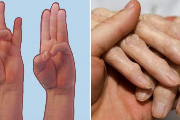 8 упражнений для рук, чтобы избавиться от боли при артрите. Почувствуй облегчение прямо сейчас!