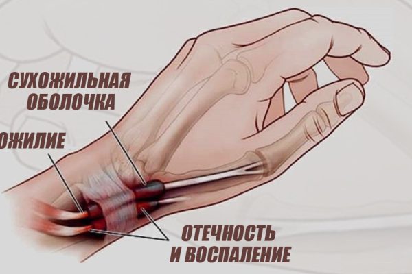 Боль в суставах проходит уже через 3 дня! Чтобы восстановить суставный хрящ, необходимо…