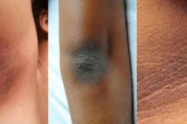 Полное руководство по удалению темных пятен на шее, локтях, коленях и в области подмышек!