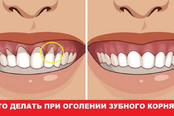 Оголилась шейка зуба? Узнай, как вернуть десну обратно!