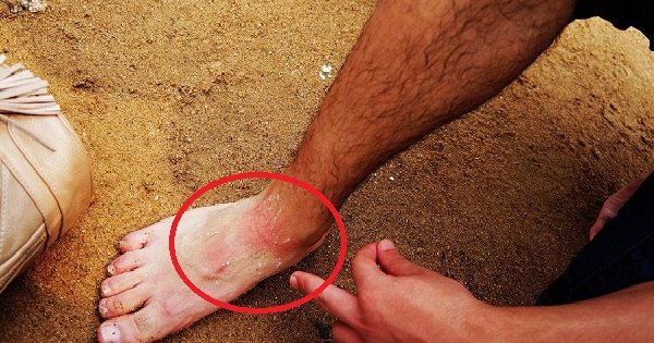 Первая помощь при укусе медузы. Это стоит прочитать всем, кто собирается на море!