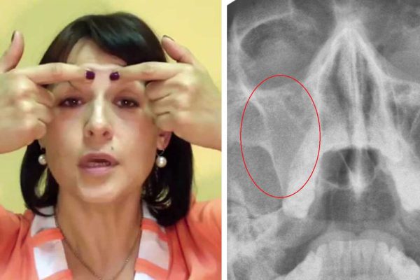 Всю жизнь страдала от застоя в пазухах, пока врач не показал эту технику. Как рукой сняло!