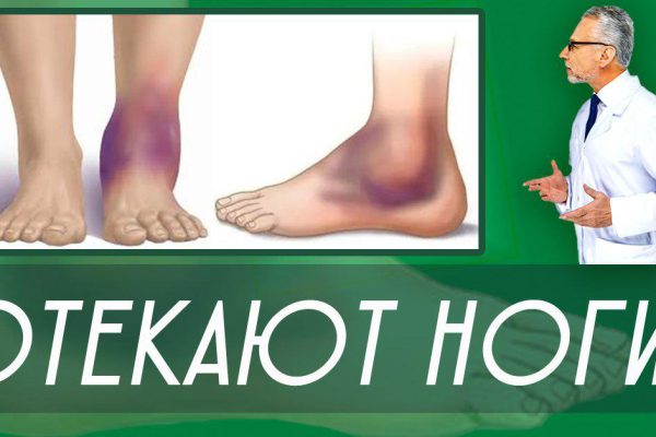 Никакой задержки жидкости, никаких отеков! «Не следует ребячески пренебрегать, если есть отеки, возьмите…»