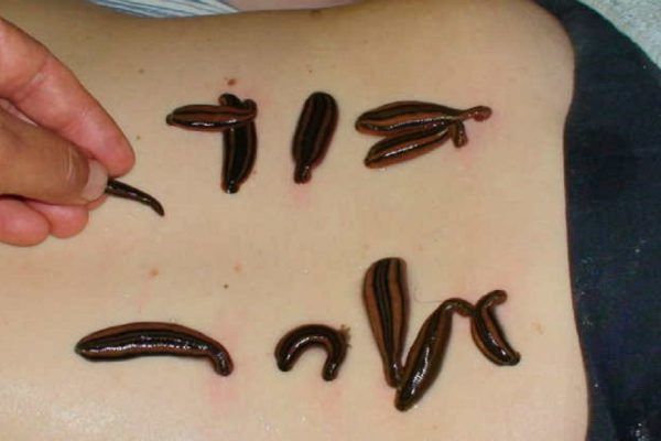 Всё, что нужно знать о гирудотерапии: метод, который ежегодно спасает тысячи людей!