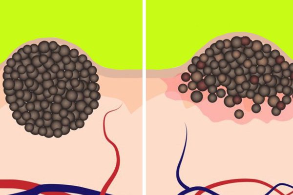 Всё о родинках и загаре: даже некоторые врачи заблуждаются