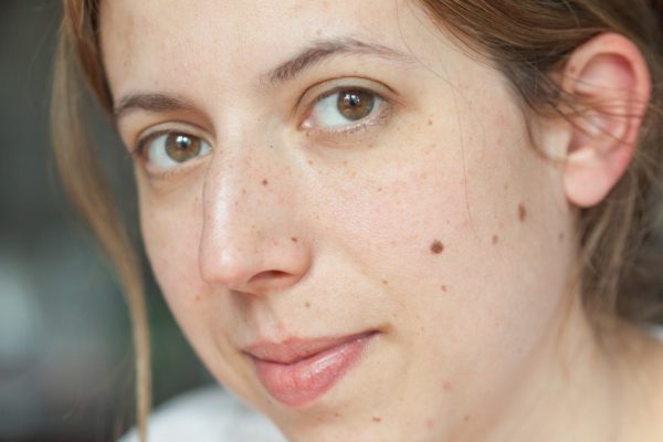 Что означают родинки на лице и теле