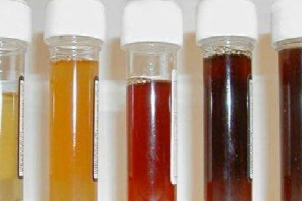 О чём говорит цвет мочи: от цистита до рака. Важная информация о состоянии организма.