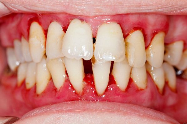 Чем грозит дефицит витамина С: ужасные последствия, о которых стоит знать!