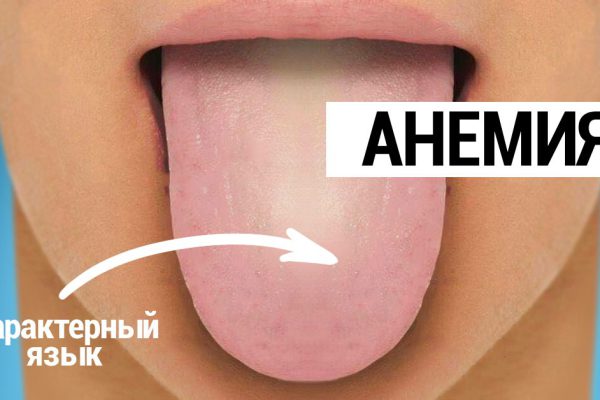Это анемия! 9 точных признаков заболевания, незаметных на первый взгляд.
