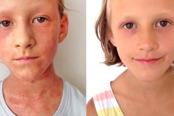 Родителям этой девочки удалось вылечить ее от экземы. Но на какие жертвы им пришлось пойти!
