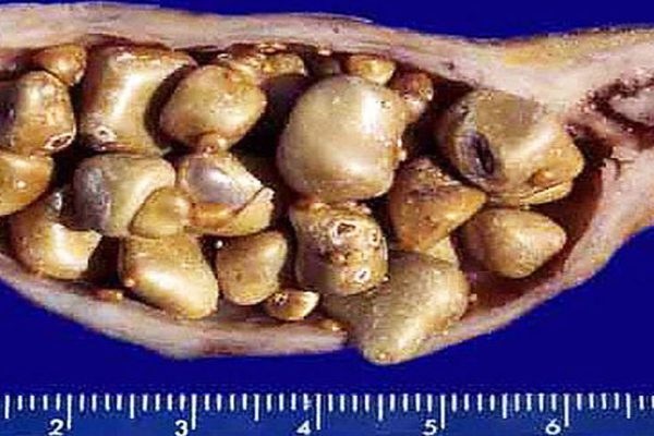 Диета от светила китайской медицины Лай Чиу Нана, помогающая убрать все камни из желчного.