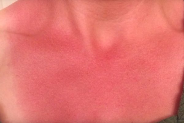 У нее был ужасный ожог, но стоило ей нанести эти 3 компонента, как он исчез!