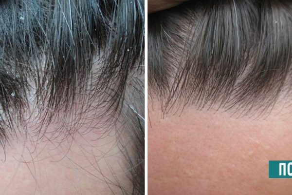 Забудь о перхоти, как о страшном сне! 5 самых эффективных средств.