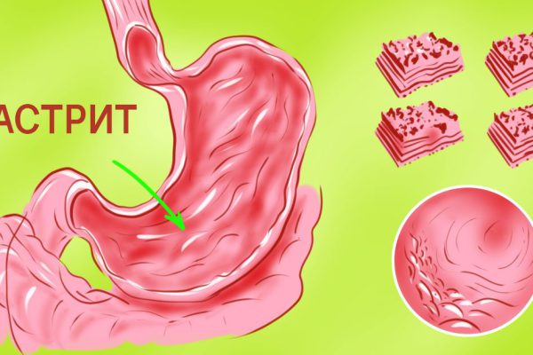Избавиться от повышенной кислотности можно за 10 дней, зная эти 5 рецептов! Если не любишь рисовую воду, попробуй…