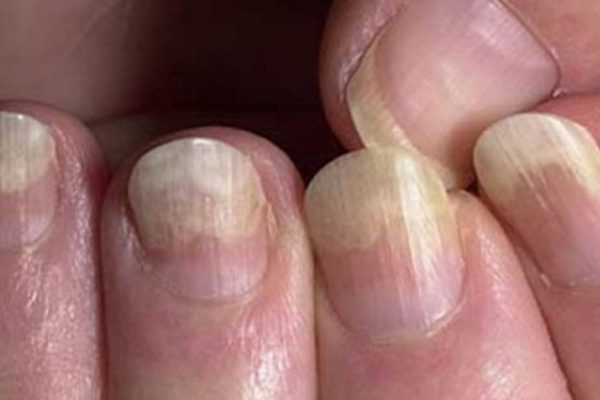 Быстрое средство от грибка ногтей