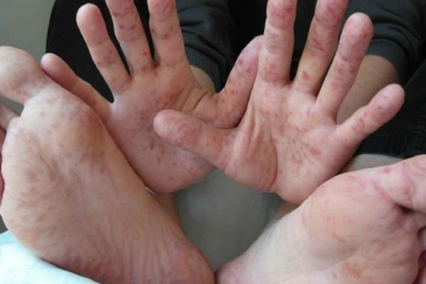 Внимание — эпидемия НОВОГО ВИРУСА! Каждый родитель должен знать эти симптомы.