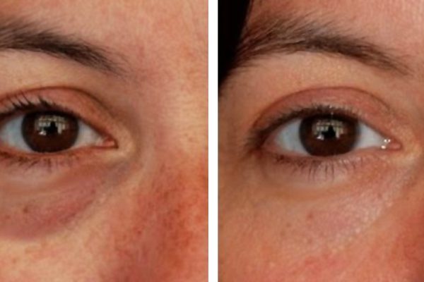 Домашний гель для кожи вокруг глаз: природные компоненты избавят от морщин!