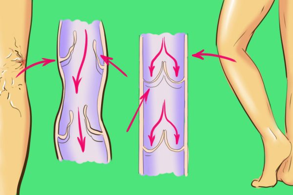 Варикоз отступит! Разгружаем вены стоя, потом лежа на спине, а в конце…