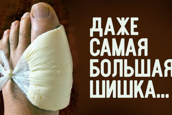 Даже самая большая шишка перестанет ныть! Чтобы суставы нижних конечностей…