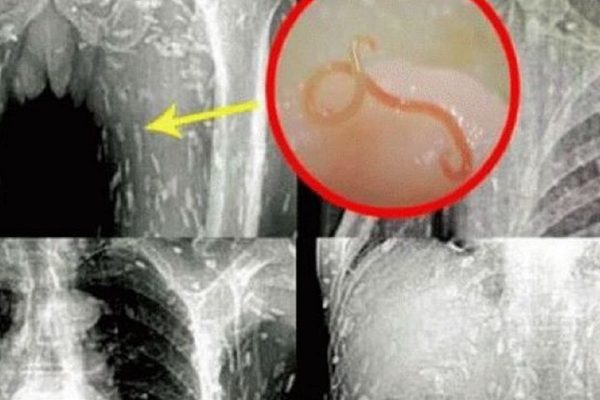 Паразиты поедают любителей этого блюда! Как не заразиться гельминтами?