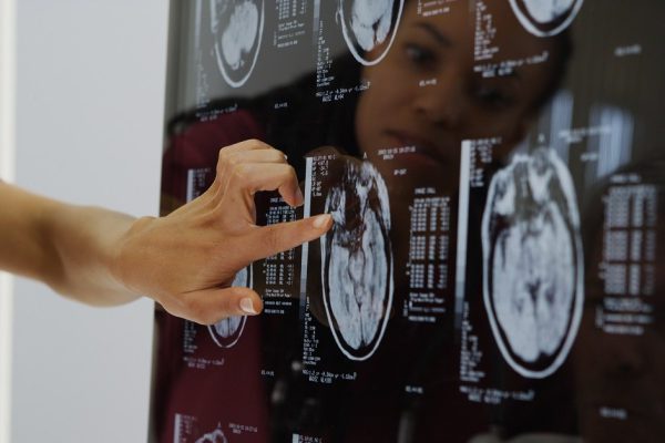 Doctors reviewing brain x-rays