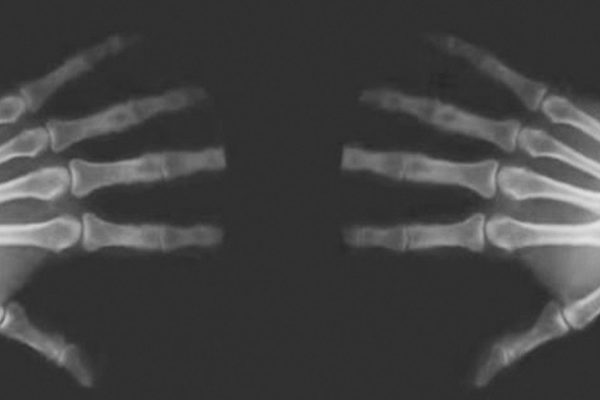 Вот что происходит, когда ты хрустишь пальцами рук. Вся правда от медицинских светил!