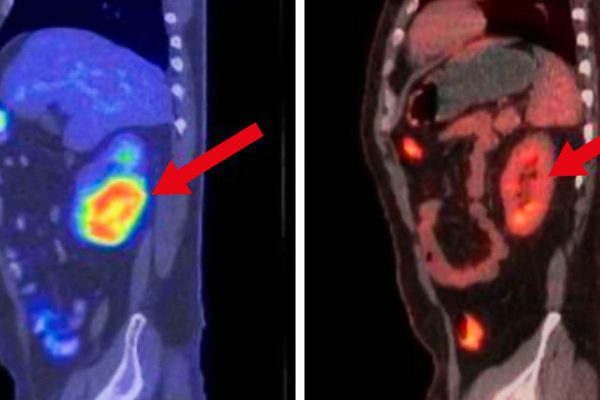 Открытие, которое дает надежду на жизнь! Иммунотерапия против рака.