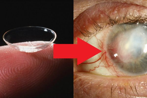 Вот что может случиться, если спать в контактных линзах: печальные последствия человеческой лени.