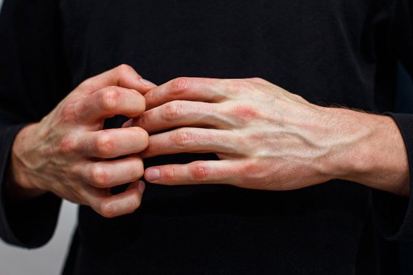 Man scratch oneself, dry flaky skin on hand with psoriasis vulgaris, eczema and other skin conditions like fungus, plaque, rash and patches. Autoimmune genetic disease.