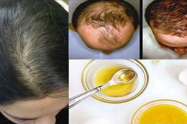 Эффективная маска и другие способы распрощаться с облысением. И нет проблемы!