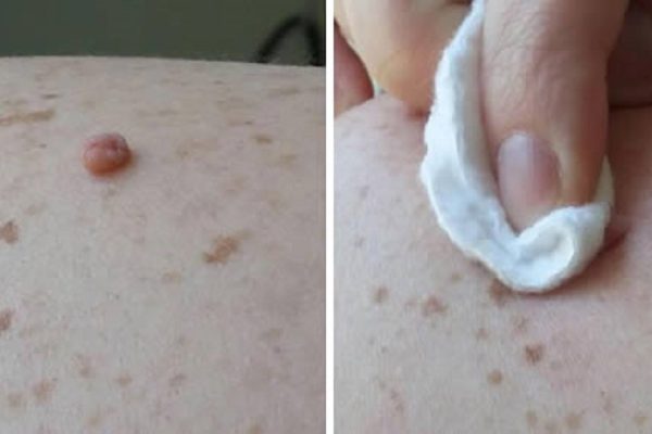 Избавься от бородавок всего за 24 часа! Поможет это натуральное средство…