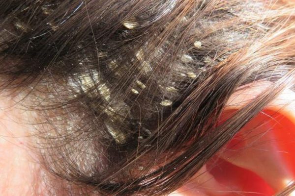 Как быстро избавиться от перхоти: 8 натуральных средств, которые вернут волосам прежнюю красоту!