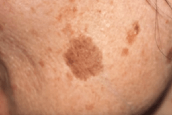 Простой трюк, который поможет избавиться от пигментных пятен! Всего 1 компонент.