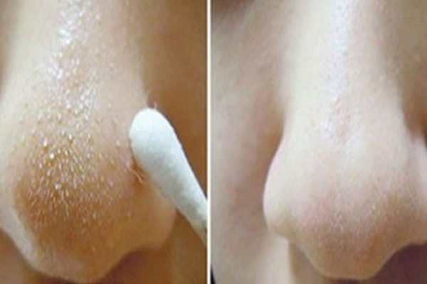 Как убрать черные точки на носу: индийский секрет поможет избавиться от гадкой проблемы!