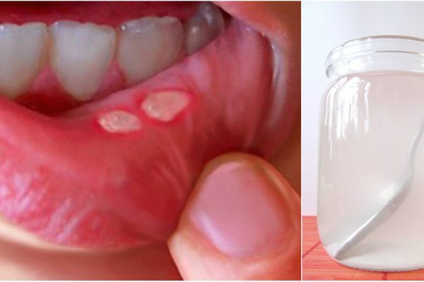 Как вылечить стоматит в домашних условиях: средство, которое работает безотказно.