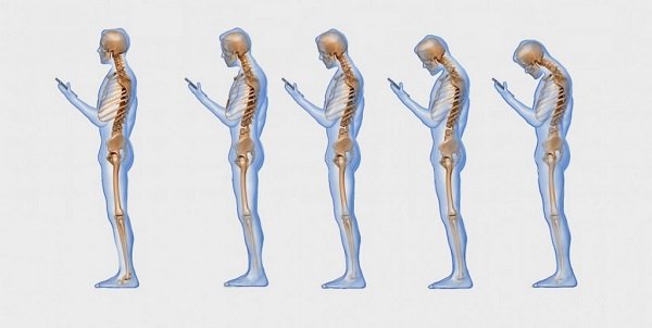 искривление позвоночника