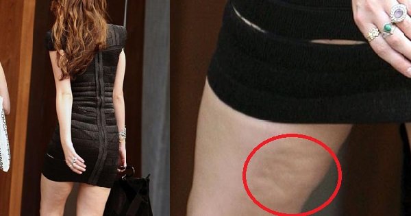 Как избавиться от целлюлита: 6 простых шагов к идеальному телу.