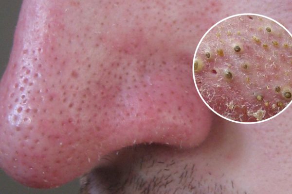 Избавься от этих гадких черных точек немедленно! И вот как это делается…