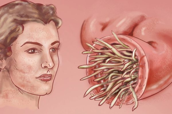 Врачи-паразитологи бьют тревогу! 95 % населения заражены паразитами…