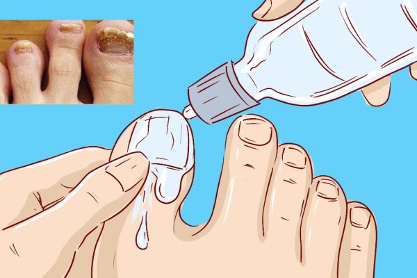 Даже запущенный грибок можно вылечить дома. Просто не забывай два раза в день мазать…