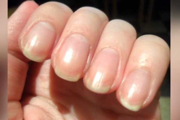 Надоело кормить аптеки? Грибок «смоется» за 3 дня, если использовать 2…