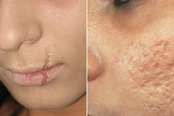 Всего 3 ингредиента помогли мне избавиться от шрамов и рубцов! Записывай рецепт…